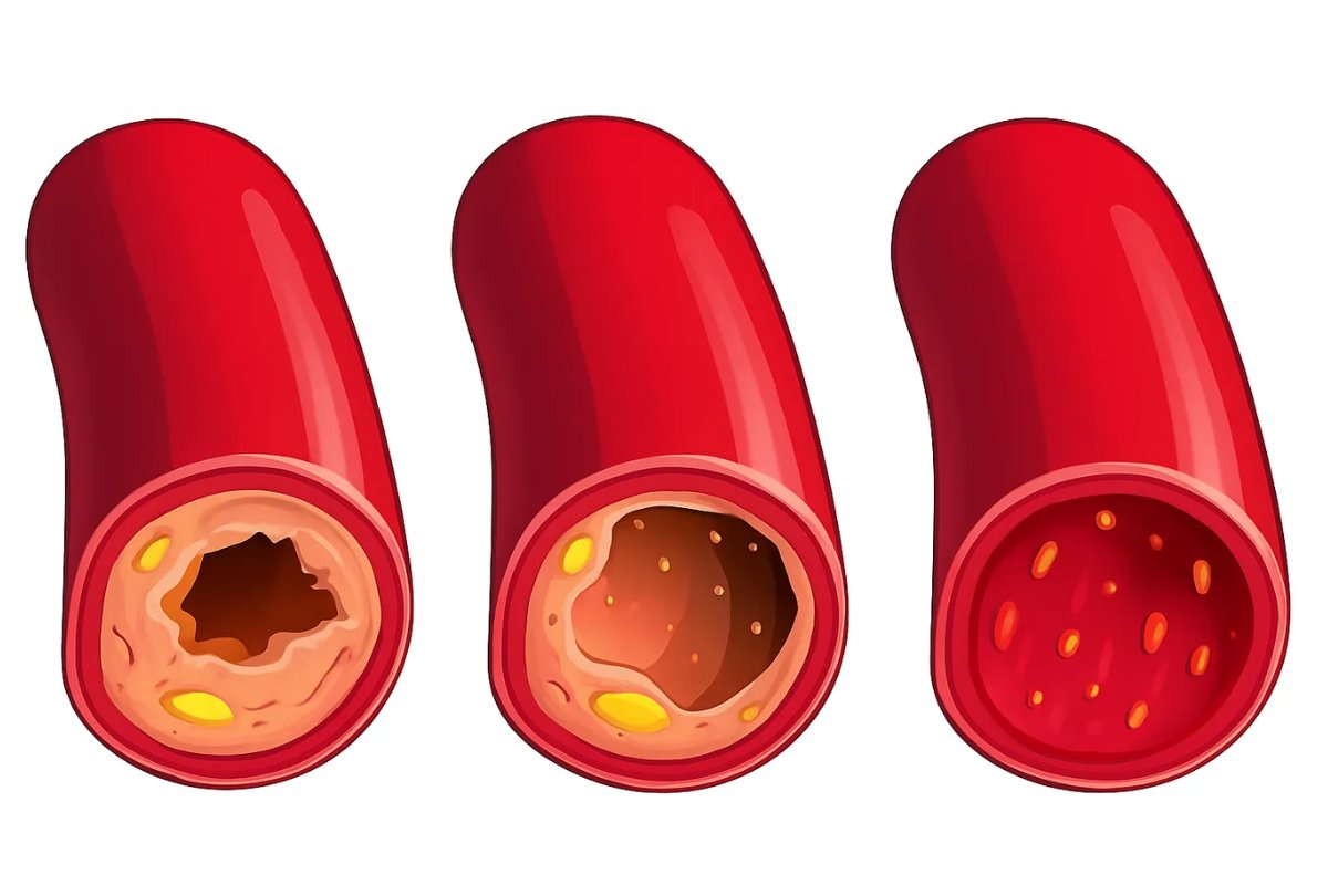 Fortschreiten von Cholesterinablagerungen in Arterien